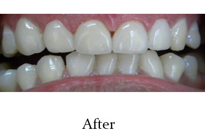 Best Orthodontic Treatment in nagpur